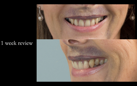  Figure 44 1 week review - showing external bruising - this resolved in 2 weeks