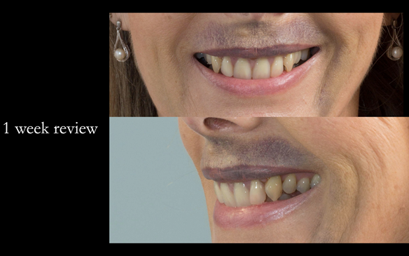 Figure 44 1 week review - showing external bruising - this resolved in 2 weeks
