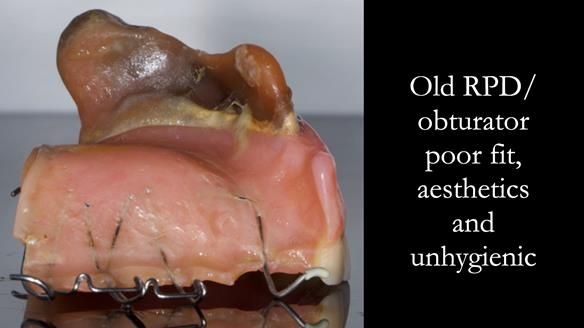 Upper metal base partial denture/occlusal stabilisation splint/obturator - full protocol
