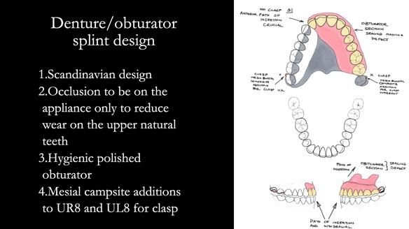 Upper metal base partial denture/occlusal stabilisation splint/obturator - full protocol