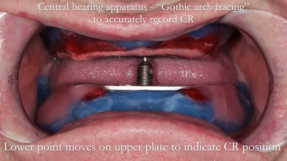 Newsletter 57 showcases the making and fitting process of implant-supported complete dentures for Alisdair
