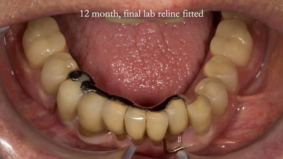 Ken – going downhill, first class