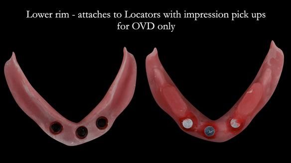 Lower pivot/rim which attaches to the implants for treatment visit 3
