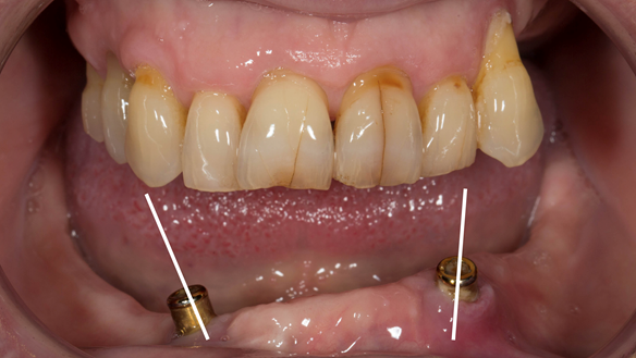 Figure 6 Divergent implants - over 30 degrees