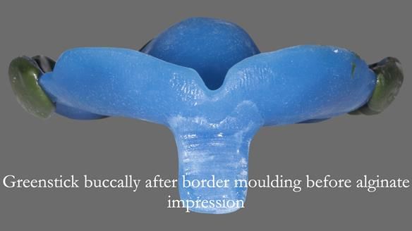 Newsletter 53 showing the making and fitting of ultra life-like dentures for Valena