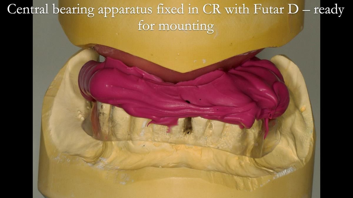 Newsletter 87 – Father Peter: A Partial Denture that needed Minor Miracle