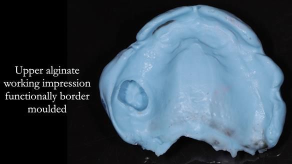 Finlay's Newsletter 58 Gasket upper partial denture for Zoe