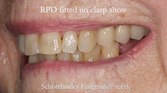 Finlay's Newsletter 60 Sylvia's upper Kennedy Class 2 Mod 1 metal based upper RPD