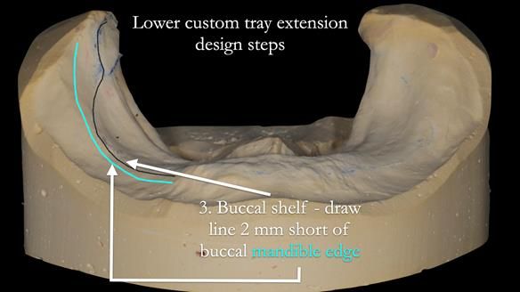 Newsletter 50 Special edition Complete Dentures FULL PROTOCOL