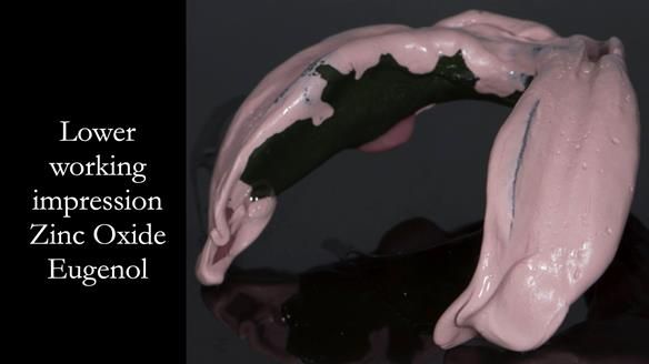 Newsletter 75: Marion’s case - Step-by-step complete denture workflow