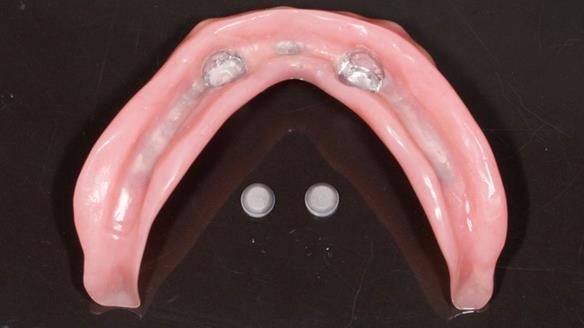 Newsletter 78: What do Clark Gable and a Locator® overdenture have in common?