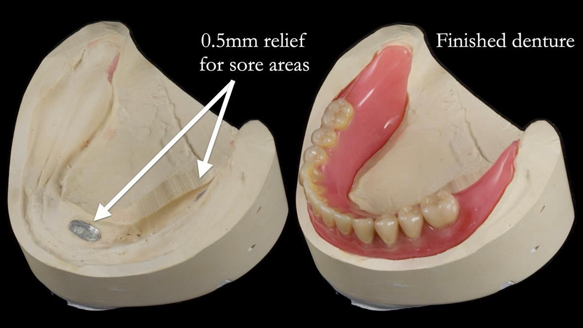 Fin’s Newsletter 88 — Complete dentures - full protocol… he rearranged his own teeth!