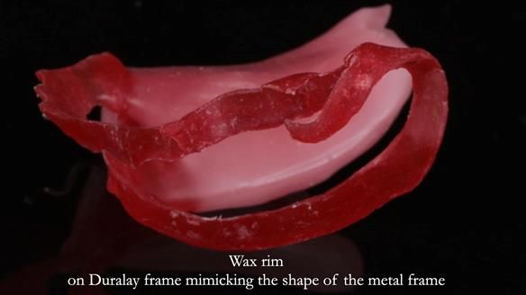 Finlay's Newsletter 61 provision of a lower unilateral free end saddle metal based partial denture for Joyce