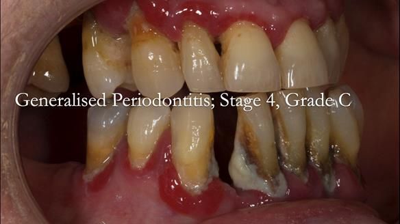 Finlay's Case Study Newsletter 40 - Immediate Mk 1 RPD to Definitive Mk 2 RPD - full protocol