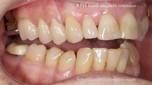 Finlay's Newsletter 60 Sylvia's upper Kennedy Class 2 Mod 1 metal based upper RPD