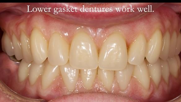 Finlay's Newsletter 58 Gasket upper partial denture for Zoe