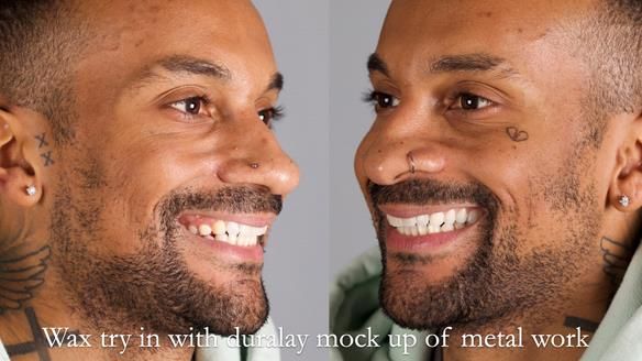 Upper metal base partial denture/occlusal stabilisation splint/obturator - full protocol