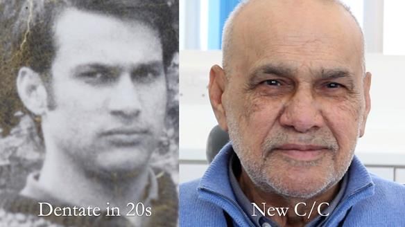 Managing poor implant positioning with complete dentures and Locator attachments - full protocol Newsletter 41