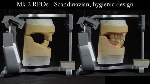 Finlay's Case Study Newsletter 40 - Immediate Mk 1 RPD to Definitive Mk 2 RPD - full protocol