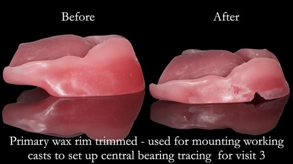 Newsletter 54 case presentation upper complete denture and lower Scandinavian designed hygienic partial denture for David