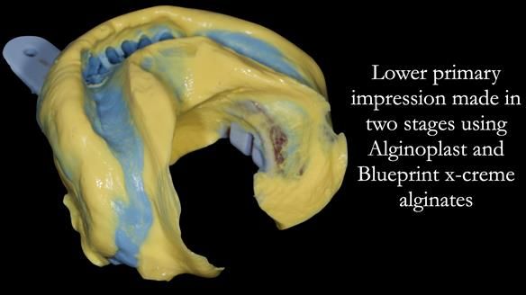 Newsletter 52 Managing Jo’s failing dentition with extractions and Mk 1/Mk 2 complete upper dentures and lower partial dentures FULL PROTOCOL