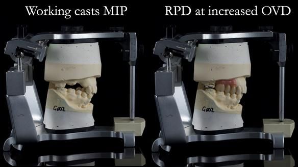 Finlay's Newsletter 60 Sylvia's upper Kennedy Class 2 Mod 1 metal based upper RPD