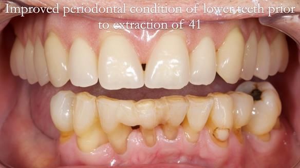 Newsletter 54 case presentation upper complete denture and lower Scandinavian designed hygienic partial denture for David