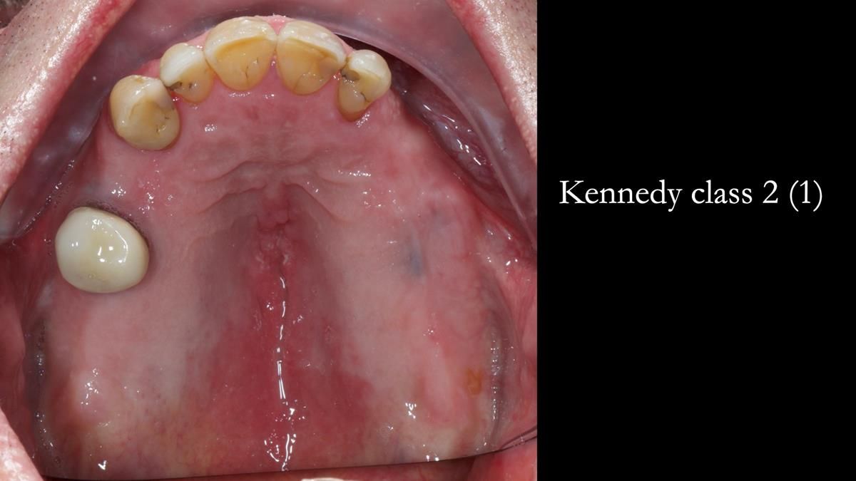 Newsletter 89 – Simon: A Challenging Kennedy Class II Division 1 Upper CoCr Partial Denture with a High Smile Line