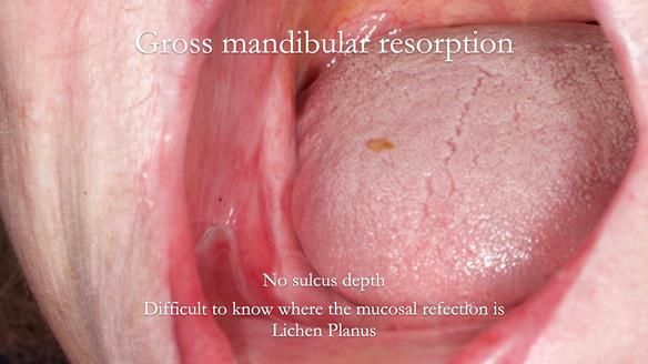 Replacing Madeline’s Complete denture FULL PROTOCOL