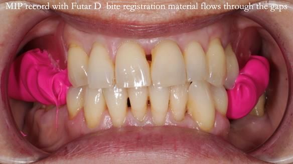 Newsletter 56 showing the making and fitting of a bilateral free end saddle upper removable partial denture (RPD) for patient with pemphigus