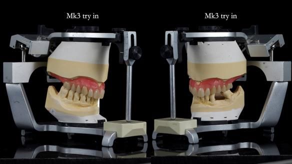 Newsletter 77: Jeremy’s case – immediate complete upper denture