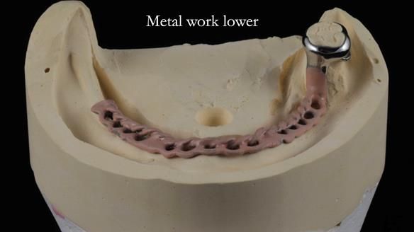 Finlay's Newsletter 59 Ultra hard partial dentures made for Gill