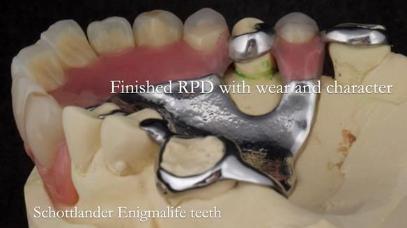 Eileen's transformation with upper and lower RPDs of Scandinavian hygienic design FULL PROTOCOL