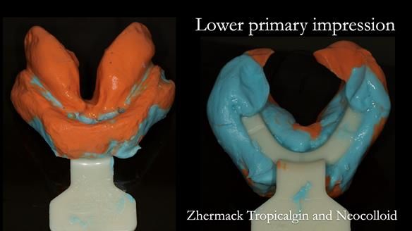 Syringe the light bodied alginate from the retromylohyoid region around the lingual sulcus over the retromolar pad and around the buccal and labial sulcus. A “frame cut back tray” (available from Metrodent) is loaded with heavy bodied alginate.