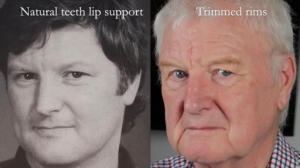 Newsletter 57 showcases the making and fitting process of implant-supported complete dentures for Alisdair