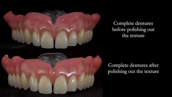 Newsletter 78: What do Clark Gable and a Locator® overdenture have in common?