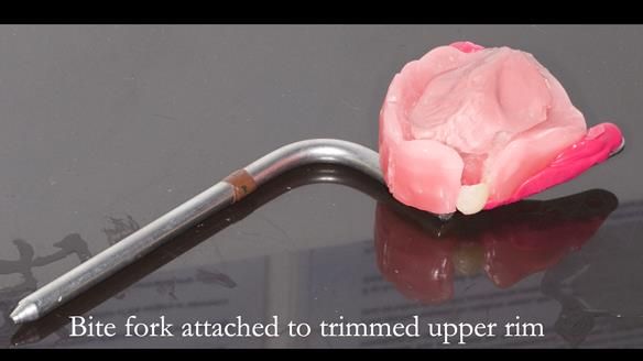 Newsletter 55 Provision of metal based partial dentures for Zephyrine with a repaired cleft lip and palate