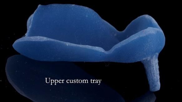 Newsletter 77: Jeremy’s case – immediate complete upper denture