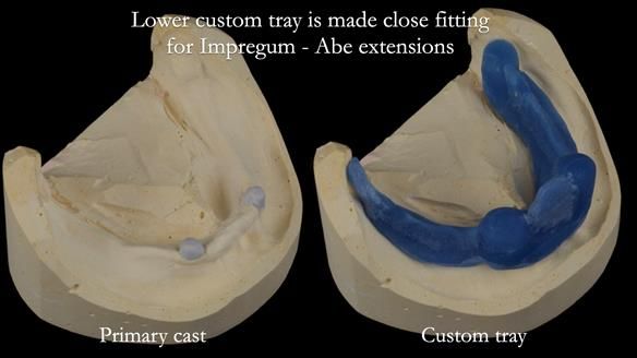 Newsletter 57 showcases the making and fitting process of implant-supported complete dentures for Alisdair