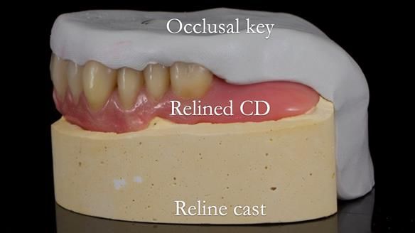 Finlay's Newsletter 62 provision of extractions and metal based complete dentures for Rafique