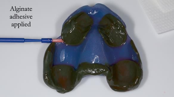 Newsletter 77: Jeremy’s case – immediate complete upper denture