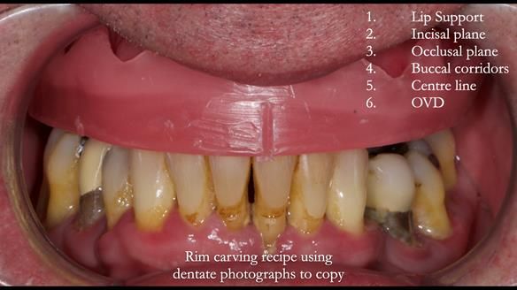 Newsletter 77: Jeremy’s case – immediate complete upper denture