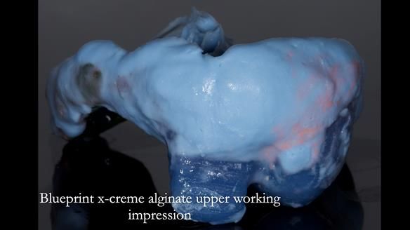 Newsletter 55 Provision of metal based partial dentures for Zephyrine with a repaired cleft lip and palate