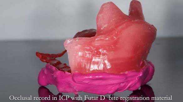 Upper metal base partial denture/occlusal stabilisation splint/obturator - full protocol