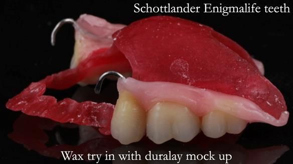 Newsletter 56 showing the making and fitting of a bilateral free end saddle upper removable partial denture (RPD) for patient with pemphigus