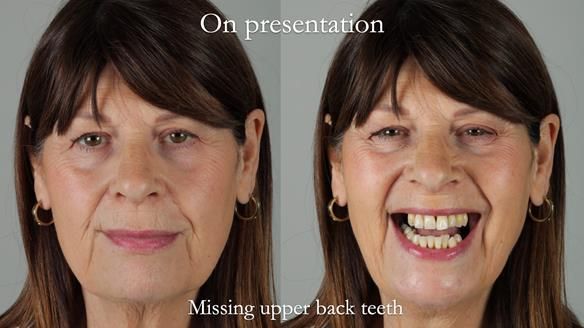 Newsletter 56 showing the making and fitting of a bilateral free end saddle upper removable partial denture (RPD) for patient with pemphigus
