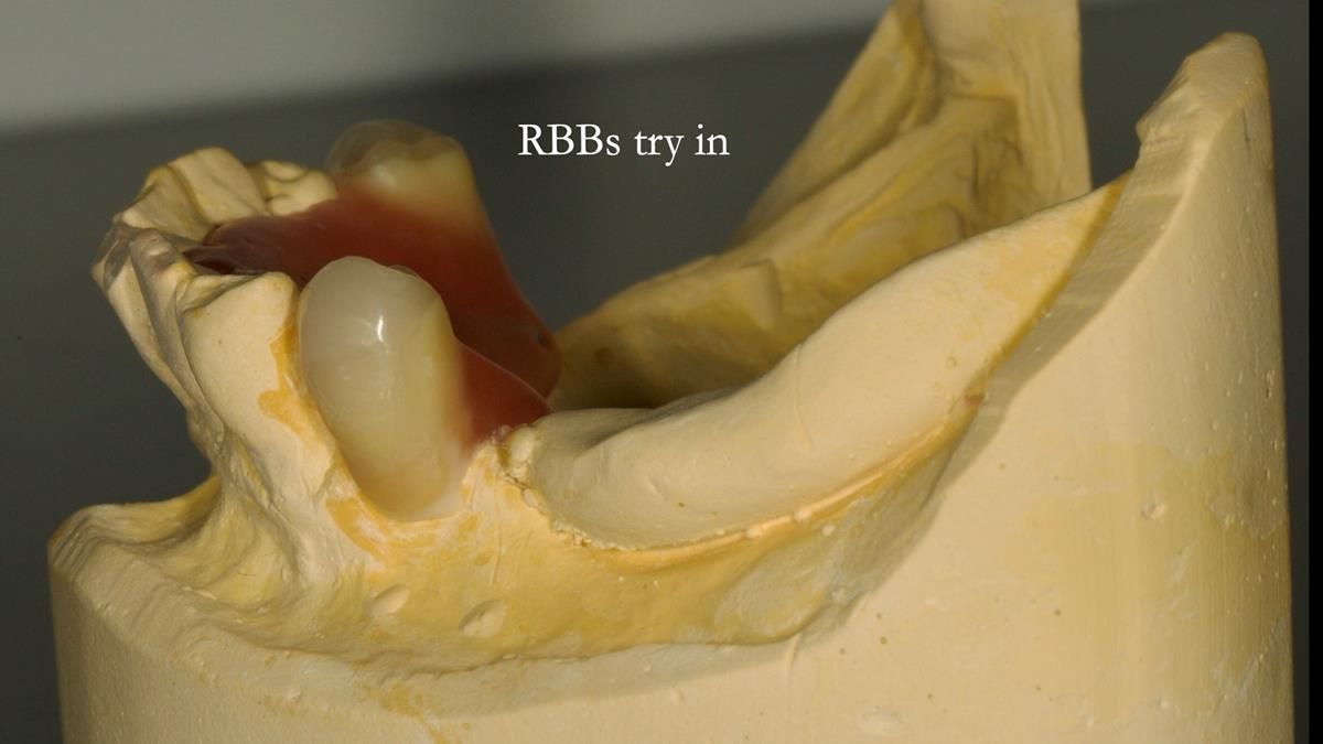 Newsletter 87 – Father Peter: A Partial Denture that needed Minor Miracle