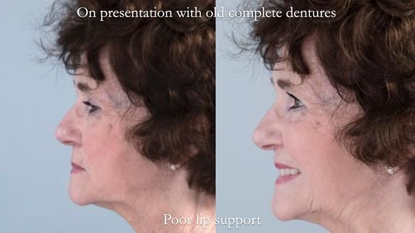 Newsletter 75: Marion’s case - Step-by-step complete denture workflow