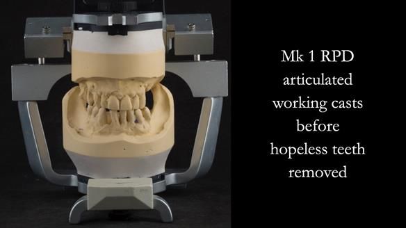 Finlay's Case Study Newsletter 40 - Immediate Mk 1 RPD to Definitive Mk 2 RPD - full protocol