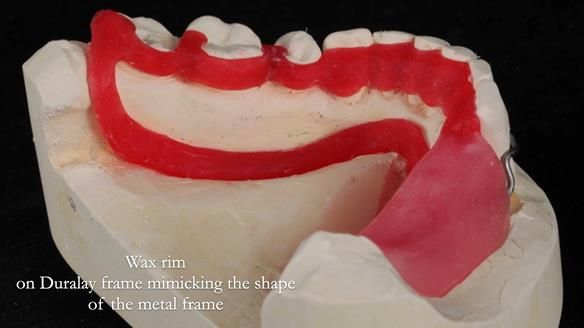 Finlay's Newsletter 61 provision of a lower unilateral free end saddle metal based partial denture for Joyce